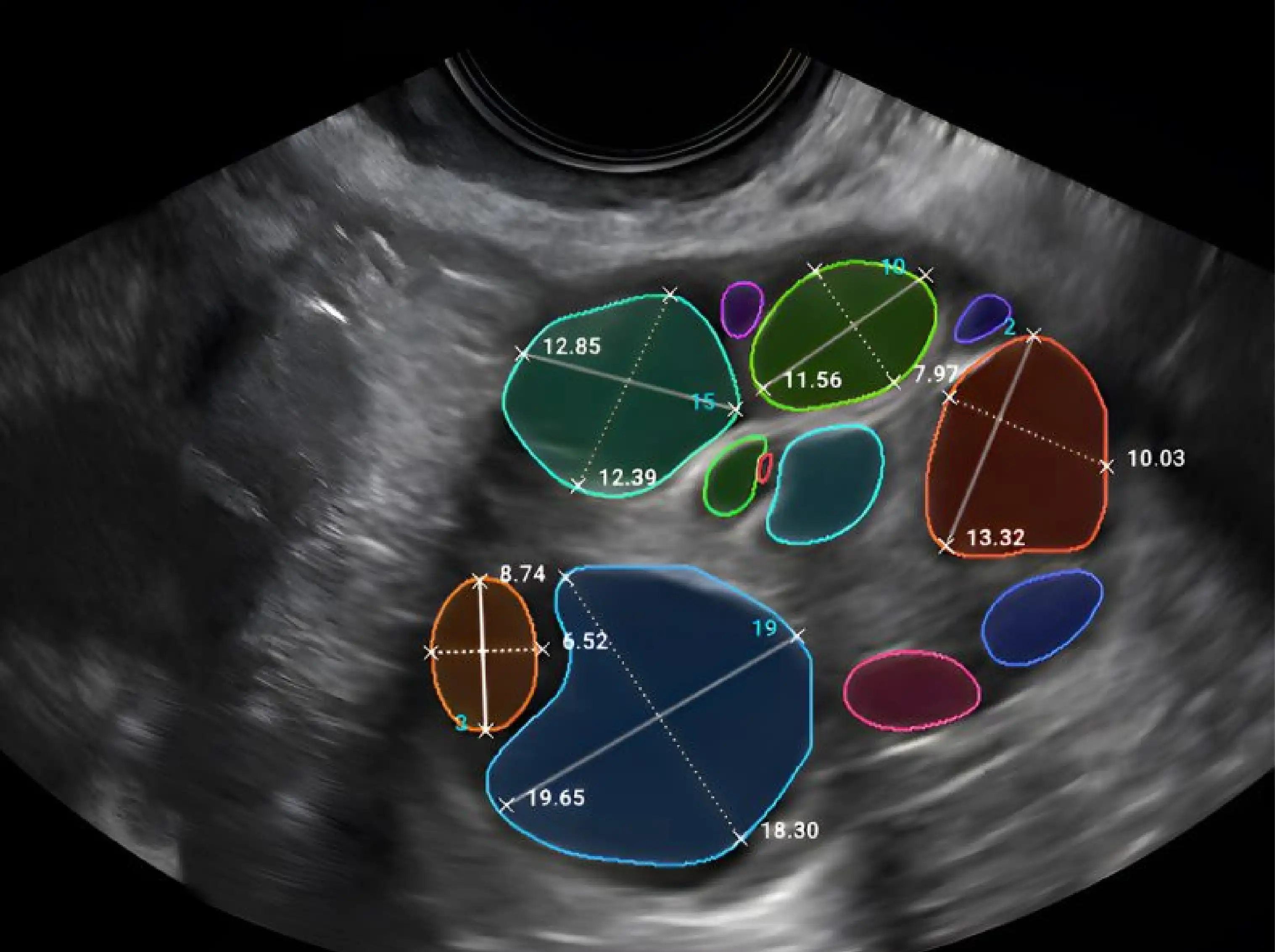 In Vitro Fertilization (IVF) | KSA